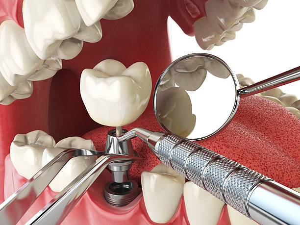 Best Emergency Root Canal Treatment in Martinsvle, IL